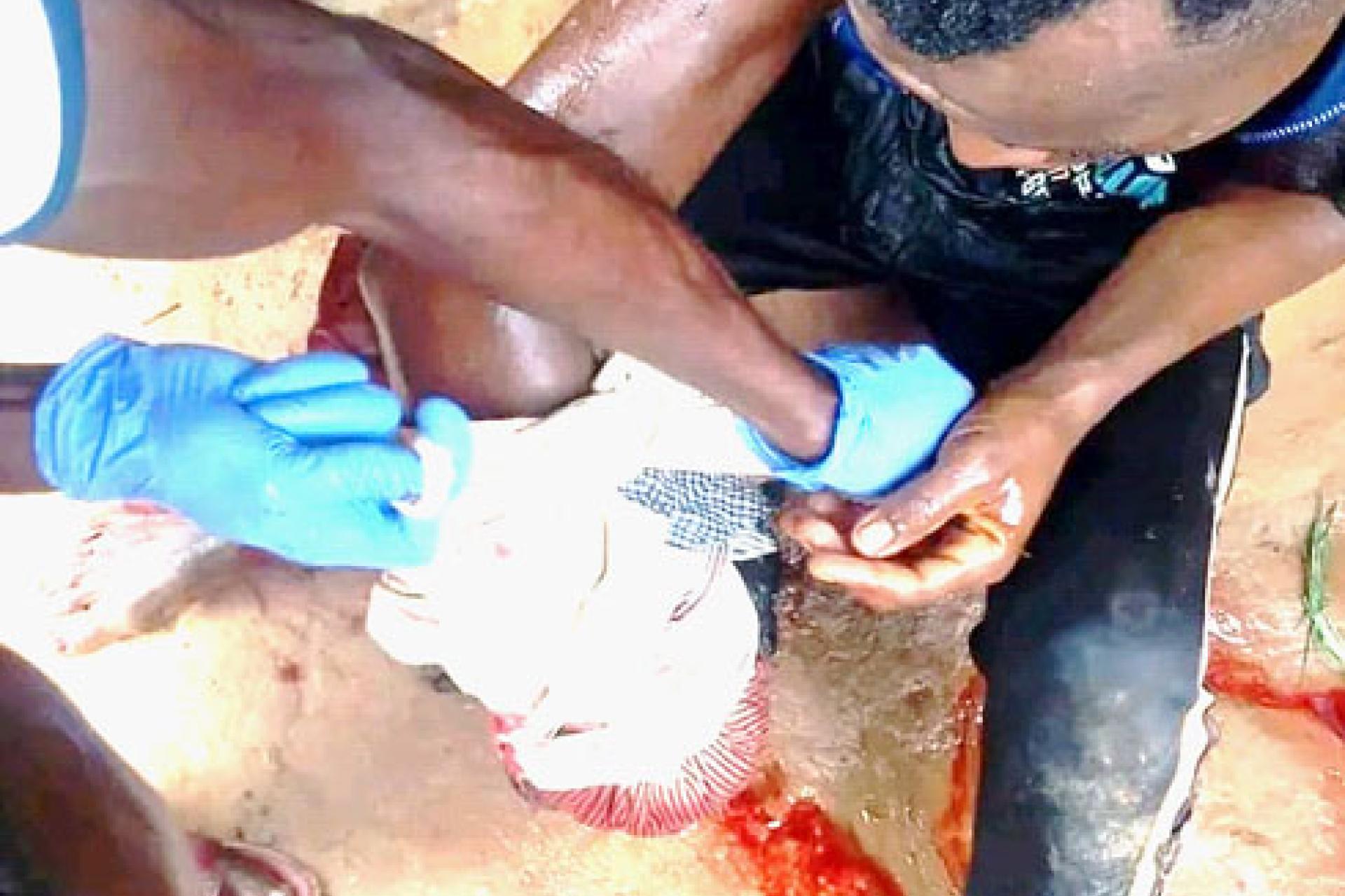 Kiluambanzila Luvuki Didier blessé par le crocodile au Kongo Centrale à Luozi. 