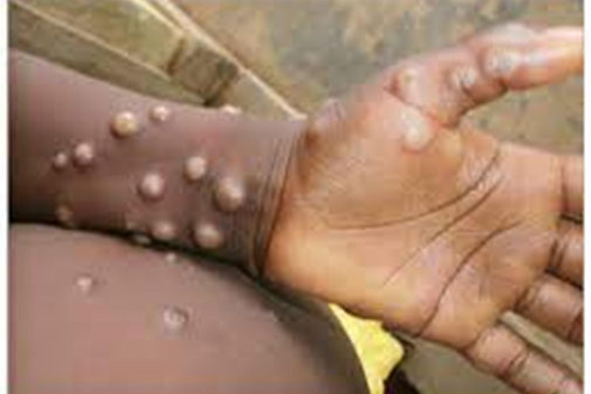 Monkeypox.jpg