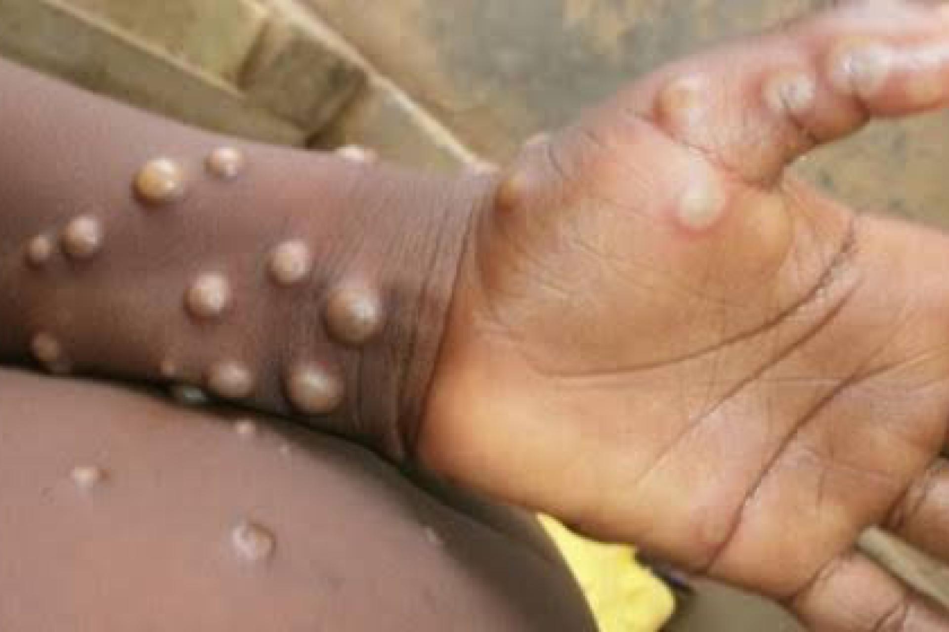 Mpox