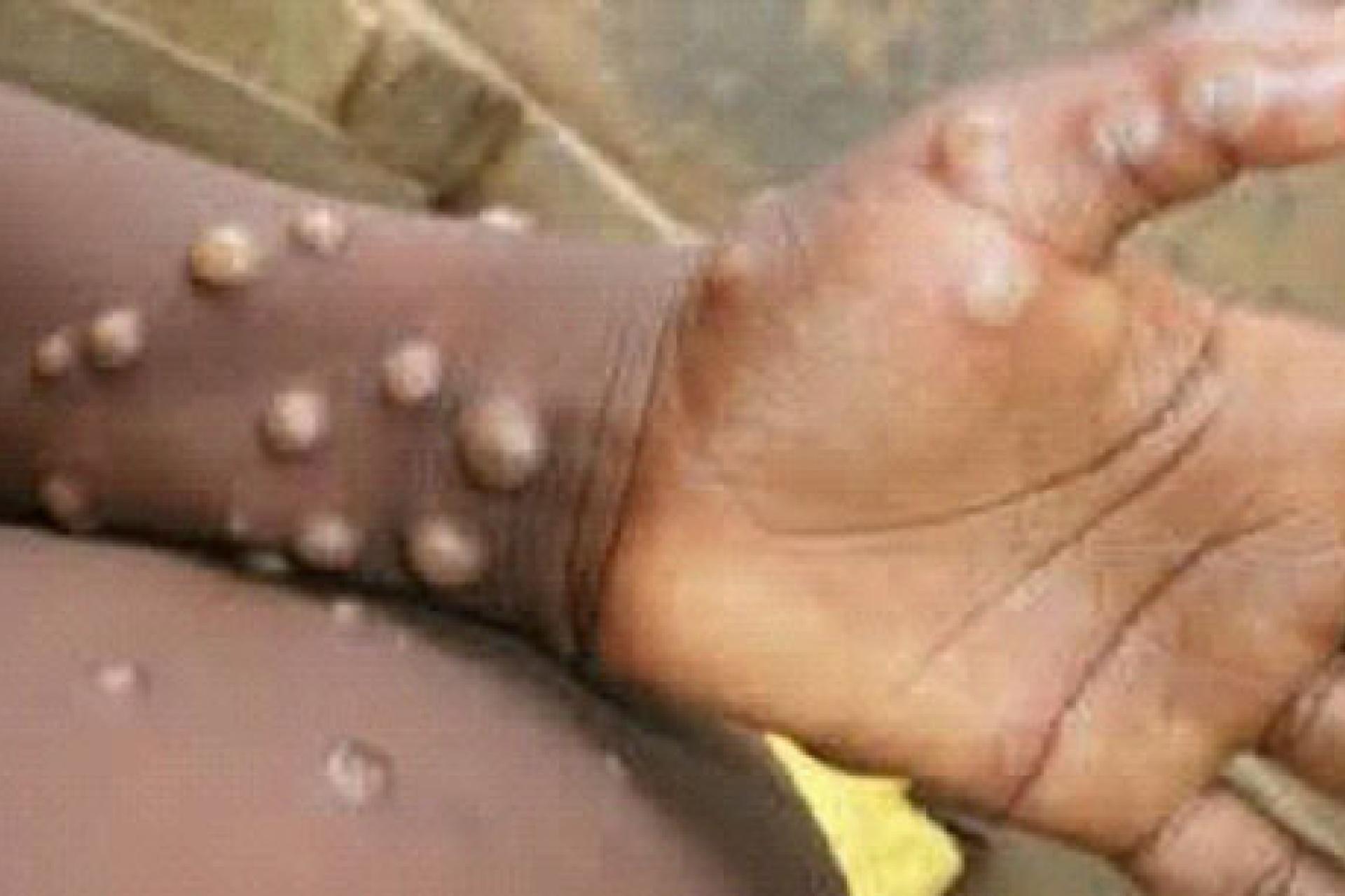 Deux cas de mpox