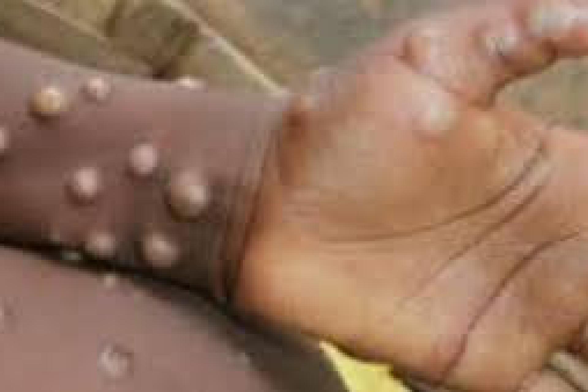 Mpox