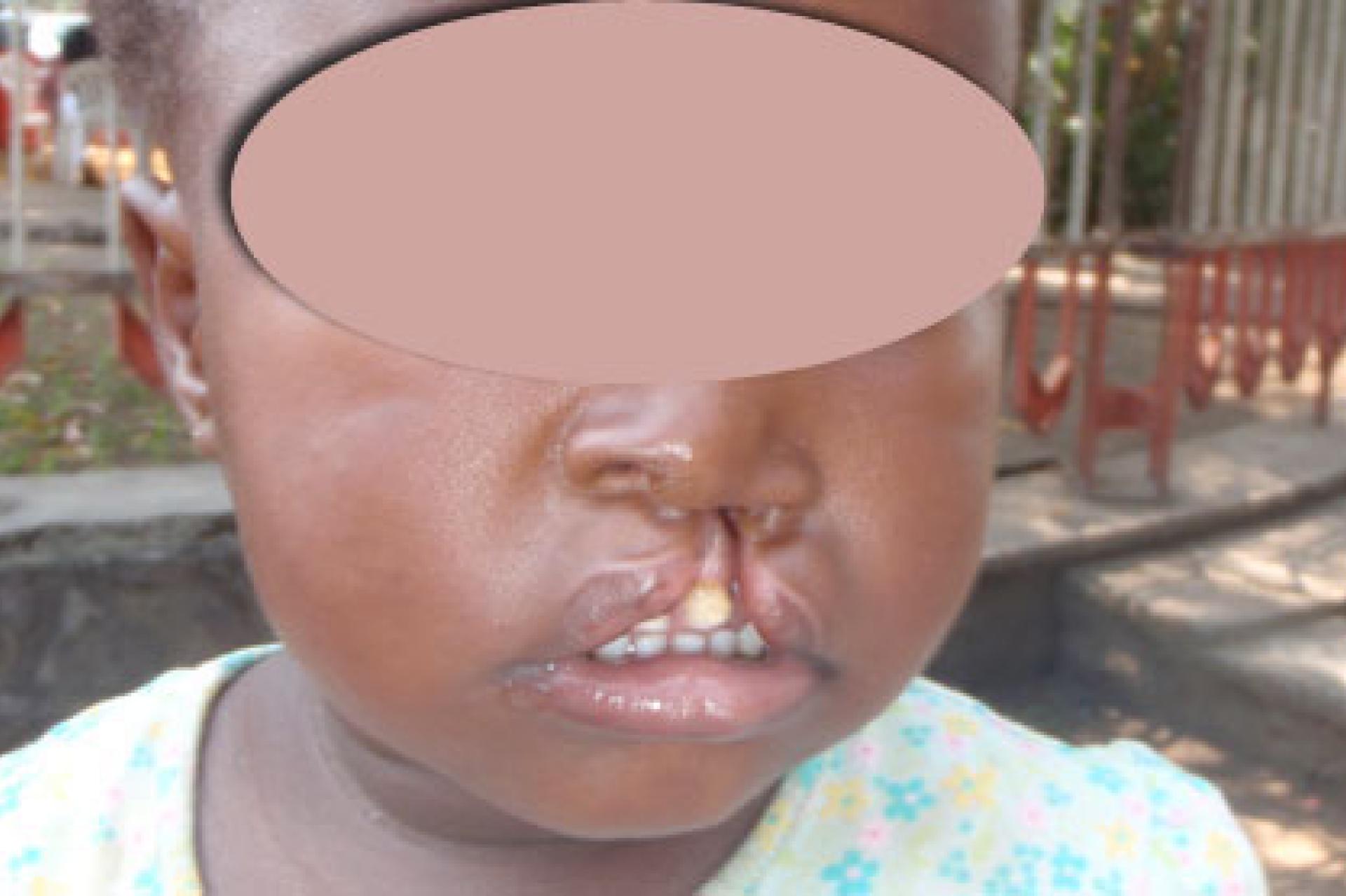 Enfant avec fente labiale