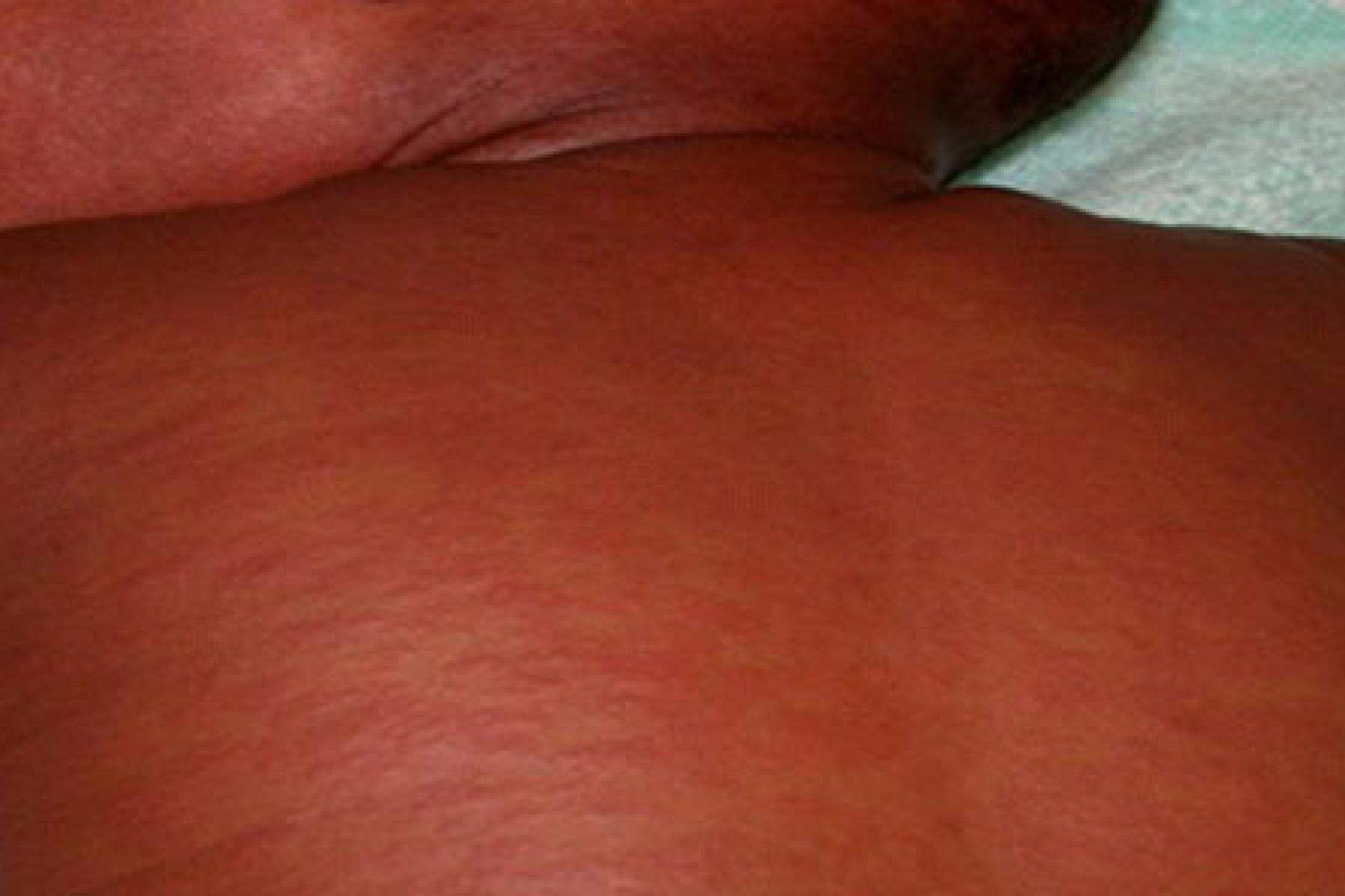 Un enfant souffrant de la rougeole.  